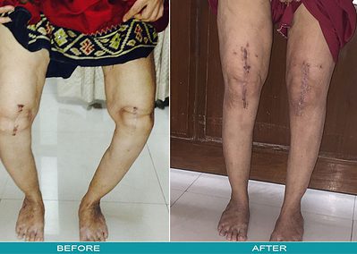 What has Changed in regard to Joint Replacement? Technique vs Technology